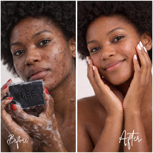 ACTIVATED CHARCOAL & TEA TREE SOAP